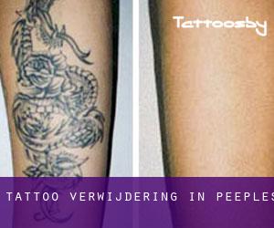 Tattoo verwijdering in Peeples