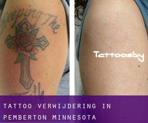 Tattoo verwijdering in Pemberton (Minnesota)