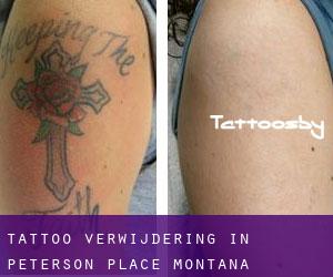 Tattoo verwijdering in Peterson Place (Montana)