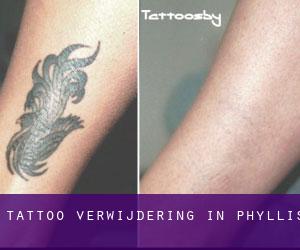 Tattoo verwijdering in Phyllis
