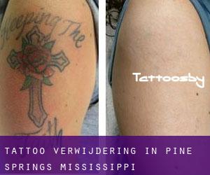 Tattoo verwijdering in Pine Springs (Mississippi)