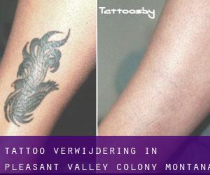 Tattoo verwijdering in Pleasant Valley Colony (Montana)