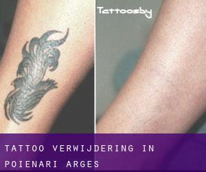 Tattoo verwijdering in Poienari (Argeş)