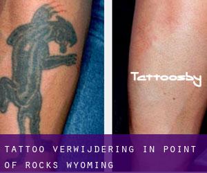 Tattoo verwijdering in Point of Rocks (Wyoming)