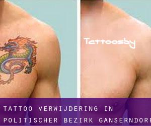 Tattoo verwijdering in Politischer Bezirk Gänserndorf