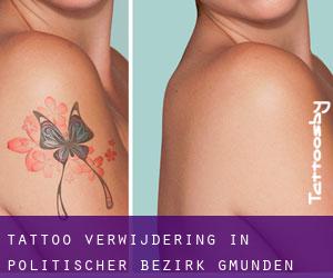 Tattoo verwijdering in Politischer Bezirk Gmunden