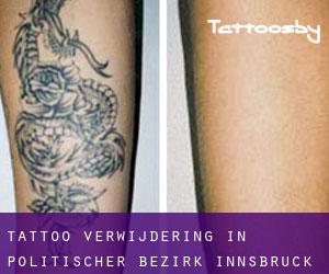 Tattoo verwijdering in Politischer Bezirk Innsbruck