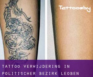 Tattoo verwijdering in Politischer Bezirk Leoben