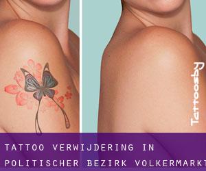 Tattoo verwijdering in Politischer Bezirk Völkermarkt