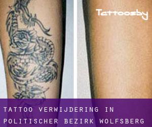 Tattoo verwijdering in Politischer Bezirk Wolfsberg