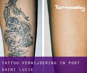 Tattoo verwijdering in Port Saint Lucie