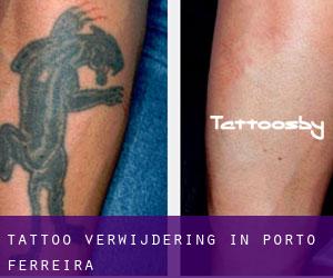 Tattoo verwijdering in Porto Ferreira