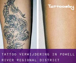 Tattoo verwijdering in Powell River Regional District