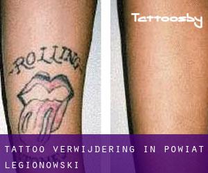 Tattoo verwijdering in Powiat legionowski