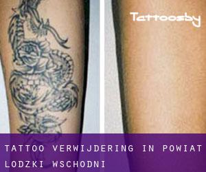 Tattoo verwijdering in Powiat łódzki wschodni