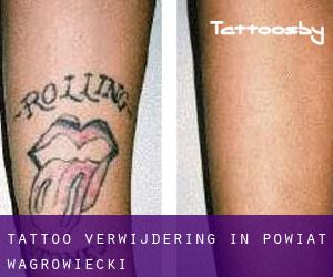 Tattoo verwijdering in Powiat wągrowiecki