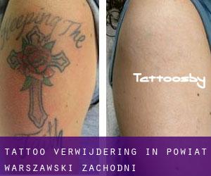 Tattoo verwijdering in Powiat warszawski zachodni