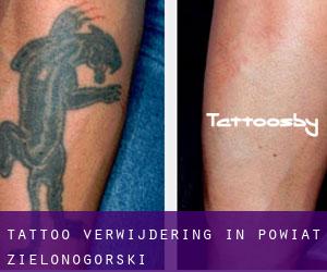 Tattoo verwijdering in Powiat zielonogórski