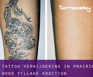 Tattoo verwijdering in Prairie Wood Village Addition