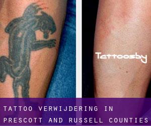 Tattoo verwijdering in Prescott and Russell Counties