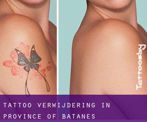 Tattoo verwijdering in Province of Batanes