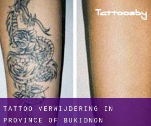 Tattoo verwijdering in Province of Bukidnon
