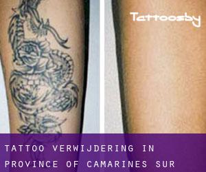 Tattoo verwijdering in Province of Camarines Sur