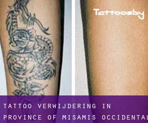 Tattoo verwijdering in Province of Misamis Occidental