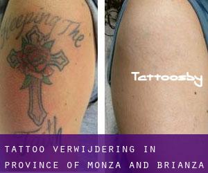 Tattoo verwijdering in Province of Monza and Brianza