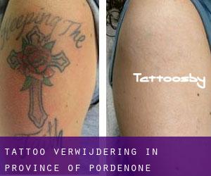 Tattoo verwijdering in Province of Pordenone