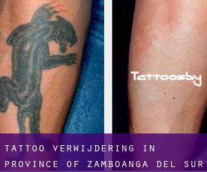Tattoo verwijdering in Province of Zamboanga del Sur