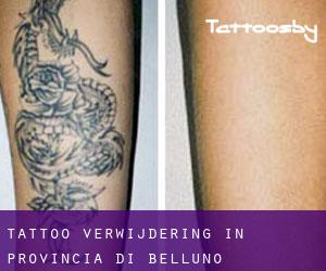 Tattoo verwijdering in Provincia di Belluno
