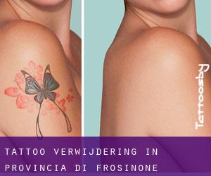 Tattoo verwijdering in Provincia di Frosinone
