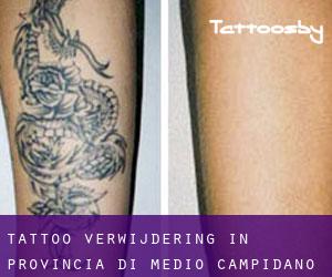 Tattoo verwijdering in Provincia di Medio Campidano