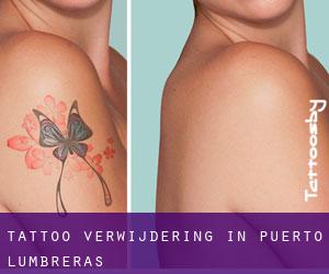 Tattoo verwijdering in Puerto Lumbreras