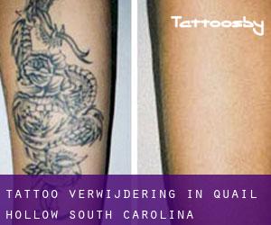Tattoo verwijdering in Quail Hollow (South Carolina)