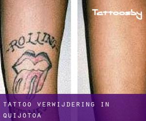 Tattoo verwijdering in Quijotoa