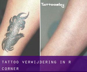 Tattoo verwijdering in R Corner