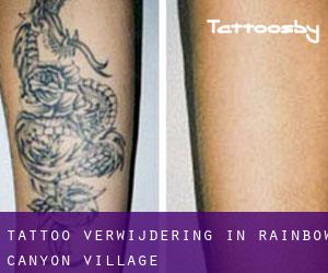 Tattoo verwijdering in Rainbow Canyon Village