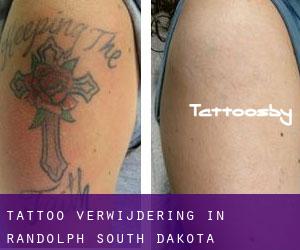 Tattoo verwijdering in Randolph (South Dakota)