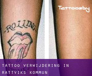 Tattoo verwijdering in Rättviks Kommun