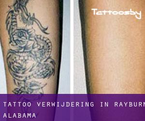 Tattoo verwijdering in Rayburn (Alabama)