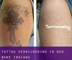 Tattoo verwijdering in Red Bank (Indiana)