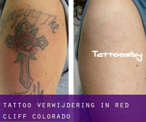 Tattoo verwijdering in Red Cliff (Colorado)