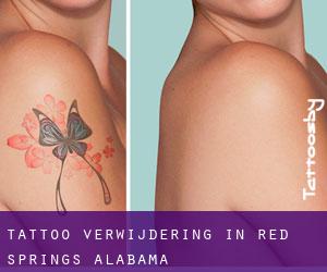 Tattoo verwijdering in Red Springs (Alabama)