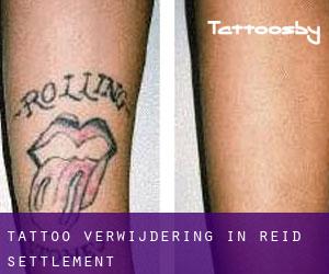 Tattoo verwijdering in Reid Settlement