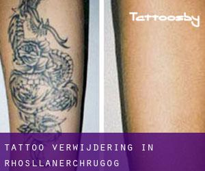 Tattoo verwijdering in Rhosllanerchrugog