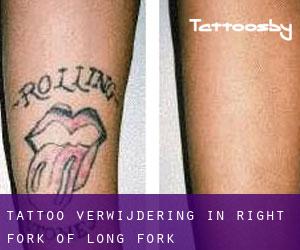 Tattoo verwijdering in Right Fork of Long Fork