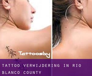 Tattoo verwijdering in Rio Blanco County