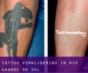 Tattoo verwijdering in Rio Grande do Sul